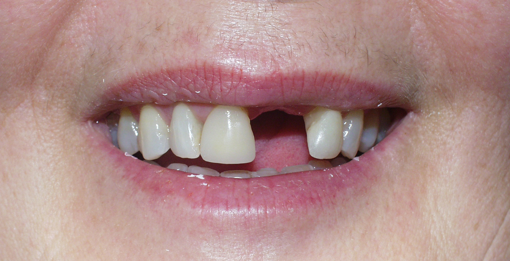 Before
