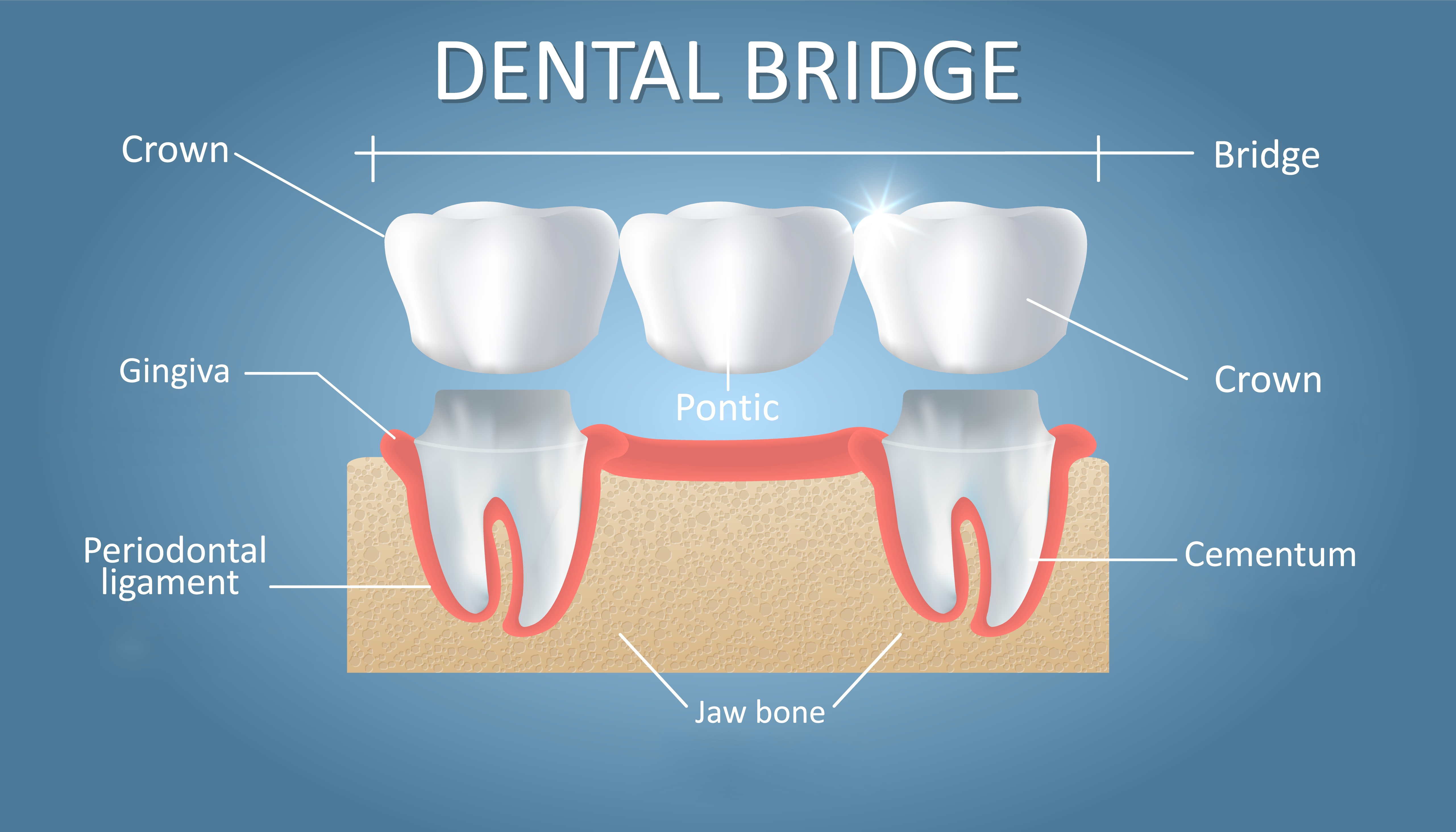 Dental Bridge