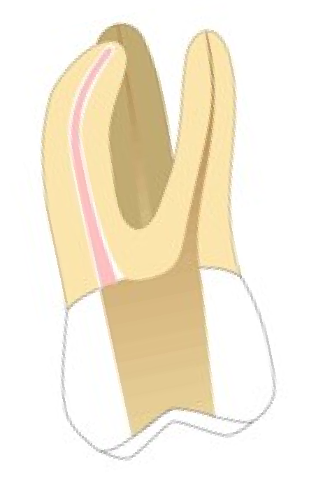 gutta percha root filling in place (pink)