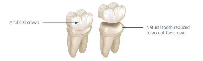 artificial crown