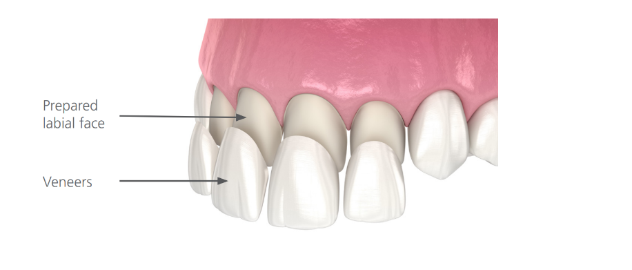 veneers